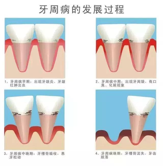 AVECMOI:牙周炎反復(fù)不見(jiàn)好 也許你需要益生菌來(lái)幫你